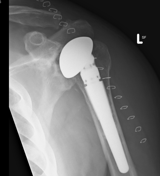 Hemiarthroplasty revised to TSR